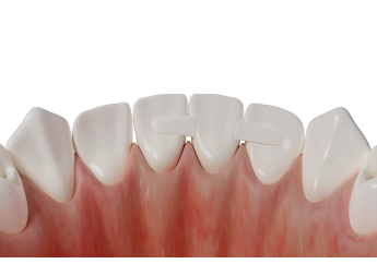 нити для шинирования и микропротезирования PFM