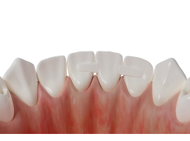 нити для шинирования и микропротезирования PFM