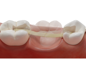 нити для шинирования и микропротезирования PFU