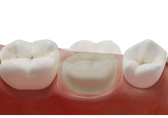 нити для шинирования и микропротезирования UFM